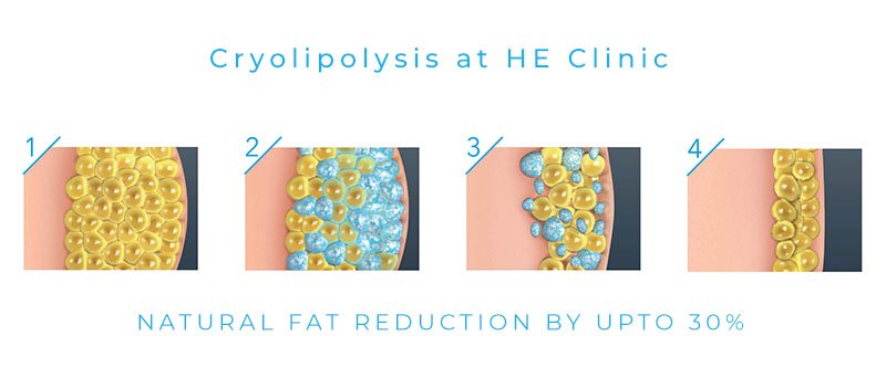 Cryolipolysis non invasive fat reduction