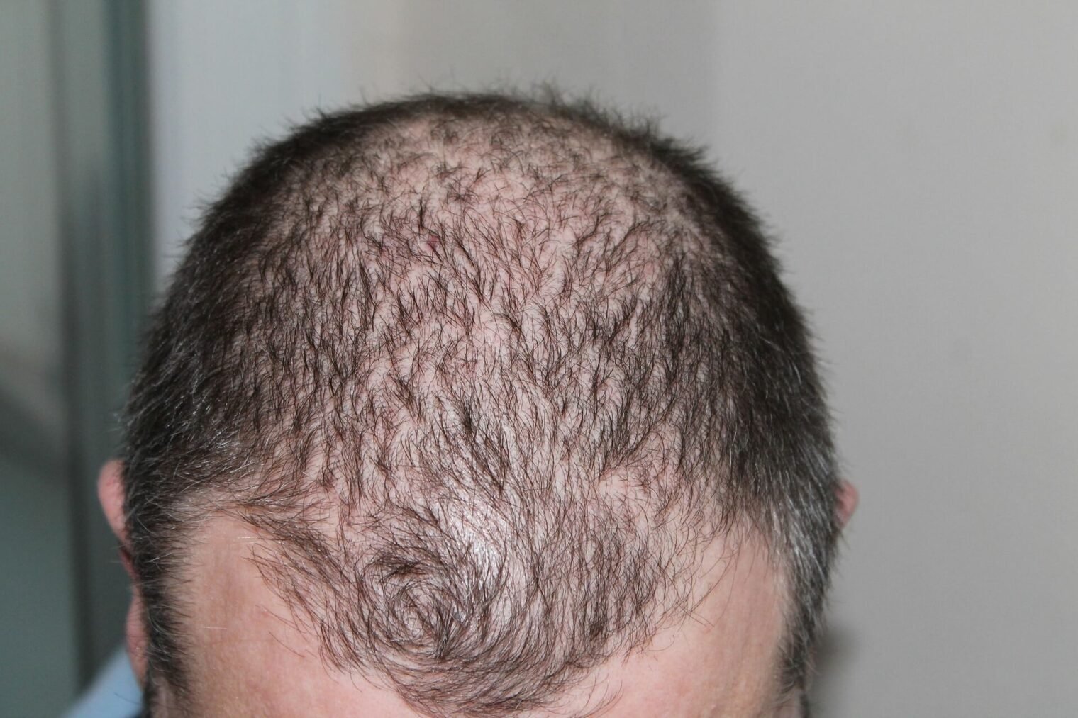 men's hair loss treatments