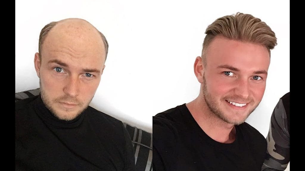 Hair transplant can change your life