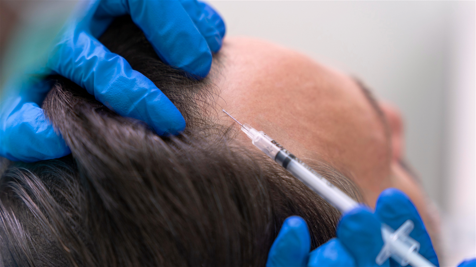 Stem cell for hair restoration
